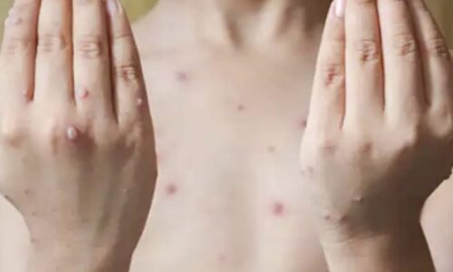 Tomato Flu बच्चों को लेने लगा है अपनी चपेट में, जानिए इसके लक्षण, बचाव और जरूरी सावधानी के बारे में